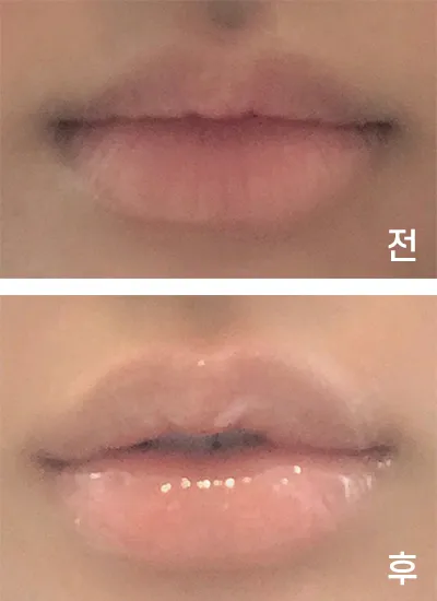 [Tiêm filler] ㅎ링ㅇ - Filler khóe miệng, môi