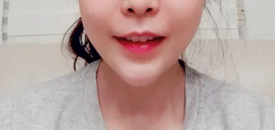 [Da] gus0311 - Filler, Nâng cơ