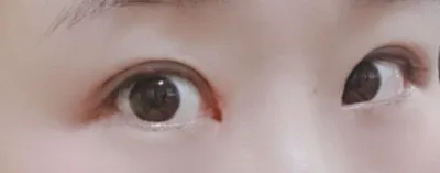 [Mắt] Pinggu Jjin - Chỉnh sửa mí mắt, mở góc mắt