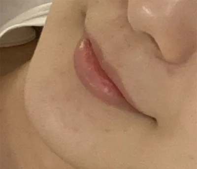 [Tiêm filler thẩm mỹ] 구름구름2 - Môi