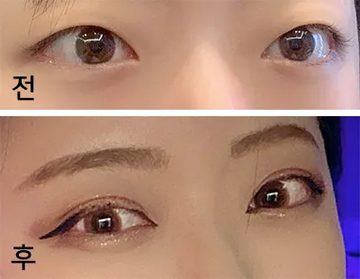 [Mắt] Chóp S2 - Mở góc mắt trên, chỉnh hình mắt