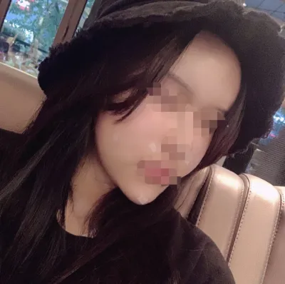 [Chống lão hóa] Gangnamjoa - Cấy mỡ