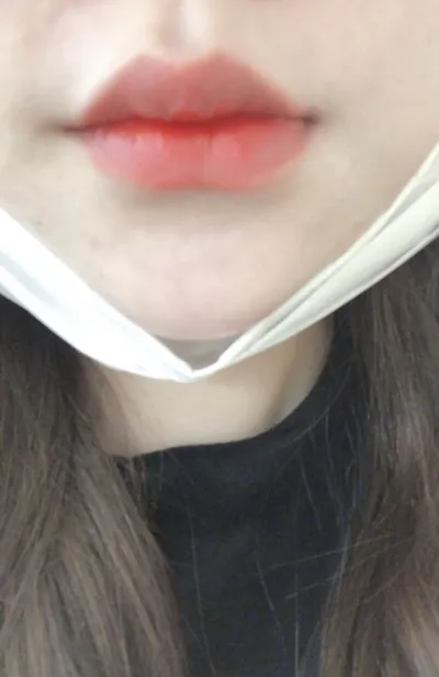 [Tiêm filler thẩm mỹ] Ririgeol - Tiêm filler môi