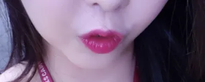 [Tiểu phẫu] Hoàng Kim Bit Leya - Filler, căng chỉ