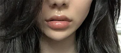 [Tiểu phẫu] Chikiin ㅇㅇ - Filler, Nâng cơ