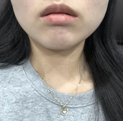 [Tiểu phẫu] soosooh - Botox, Filler