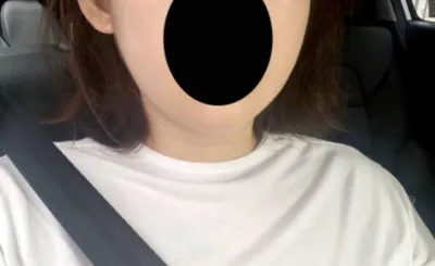 [Chống lão hóa] Plain817 - Hút mỡ mặt