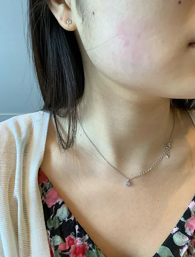 [Da] Cafe au lait - Ultherapy nâng cơ