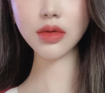 [Tiêm thẩm mỹ] Siyoring - Botox thu gọn cánh mũi