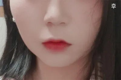 [Chống lão hóa] alss12 - Hút mỡ mặt