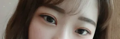 [Mắt] msdmsquf2 - Bấm mí, mở góc mắt trên