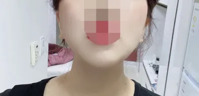 [Hút mỡ] Bimaesukhae - Hút mỡ mặt