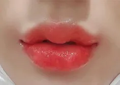 [Tiểu phẫu] Dahuiing - Filler