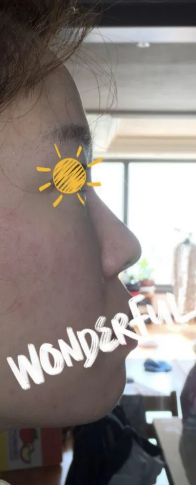 [Mũi] Shee288 - Sống mũi, Đầu mũi