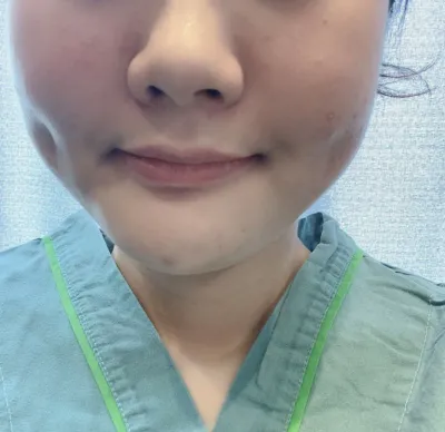 [Hút mỡ] kimy226 - Hút mỡ mặt