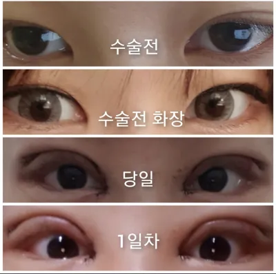 [Mắt] Go Gi-yeong - Cắt mí, mở góc mắt trên, mở góc mắt dưới