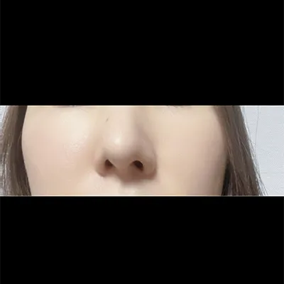 [Mũi] 232323 - Mũi