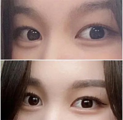 [Mắt] Yeondudoo - Cắt mí, Mở góc mắt