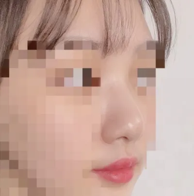 [Mũi] Longda - Phẫu thuật nâng mũi