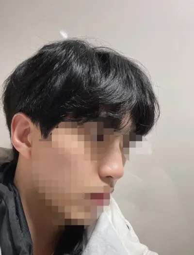 [Mũi] Minyaya - Nâng mũi (silicone, sụn vách ngăn)