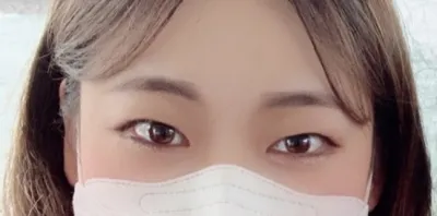 [Mắt] Daromi - Cắt mí (rạch), chỉnh sửa mắt