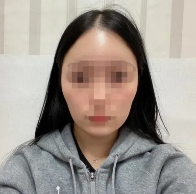 [Gọt mặt] Lemon55 - Phẫu thuật gọt hàm, thu gọn cằm