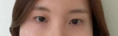 [Mắt] wyn - Mở góc mắt trong, Chỉnh sửa mí mắt