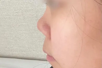 [Mũi] Jeon Ji-hyun 2 - Sống mũi