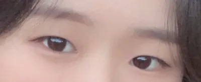 [Mắt] 0202u - Mở góc mắt trên, Cắt mí