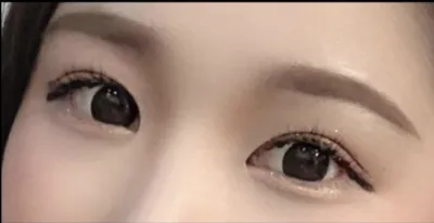 [Mắt] sidhd22 - Mở rộng góc mắt ngoài, hạ góc mắt