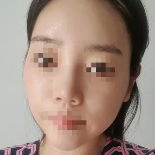 [Mũi] Màu hồng - Mũi, Đường nét khuôn mặt