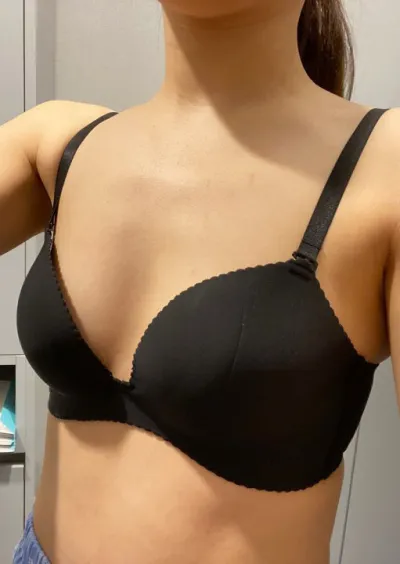 [Ngực] Lily - Nâng ngực