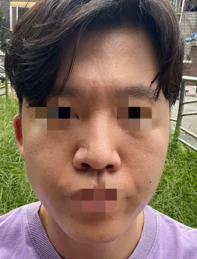 [Nam] JoAnn - Mũi, Gọt mặt