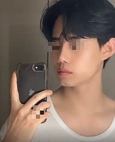 [Nam] Gấu trúc - Mũi (thẩm mỹ + chức năng)