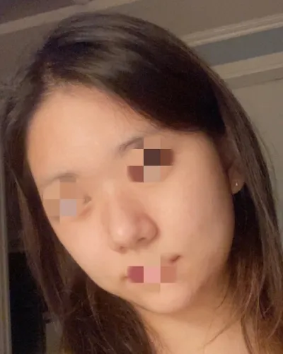 [Gọt mặt] Aishyo - Gọt mặt, mũi, hút mỡ mặt