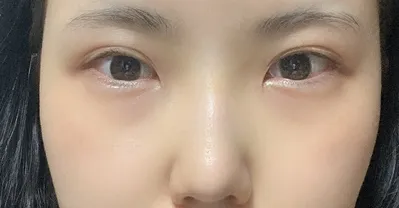 [Mắt] Sửa mắt và mũi