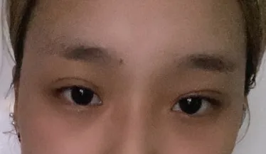 [Mũi] Melody - Gọt mặt, Mắt, Mũi