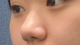 [Mũi] Nợ và góa phụ - Mũi, gò má