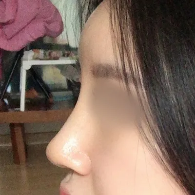 [Mũi] LIVIUS - Mũi