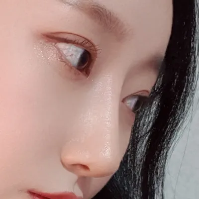 [Mũi] Olivia - Phẫu thuật mũi