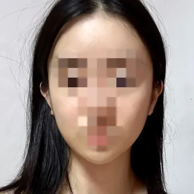 [Gọt mặt] Minvely - Gọt mặt