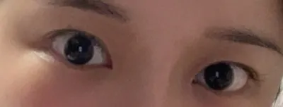 [Mắt] Supian - Mắt, Cấy mỡ