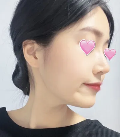 [Mũi] Bệnh viện Bebifox - Phẫu thuật mũi