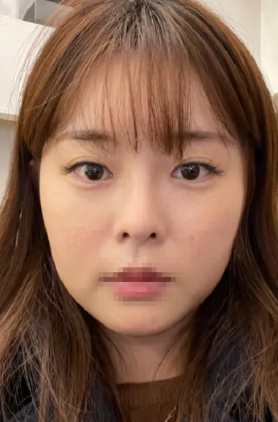 [Tạo hình khuôn mặt] Hapjeong Cafe - Mắt, mũi, hút mỡ mặt, gọt mặt