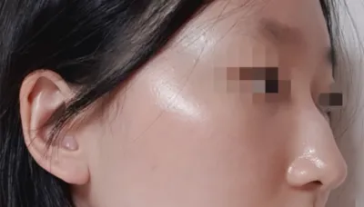 [Mũi] Pinocchio - Mũi