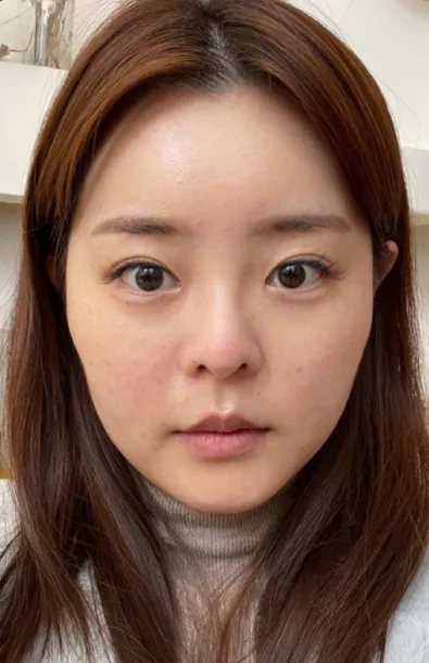 [Mắt] Thỏ con - Phẫu thuật mắt, mũi, gọt mặt, hút mỡ mặt