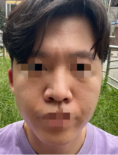 [Mũi] Sửa mũi - Mũi