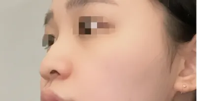 [Mũi] Hết 찌룽 - Mũi