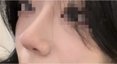 [Mũi] Mảnh thủy tinh - Mũi