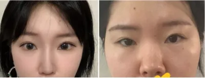 [Mắt] Mũi to - Mắt, mũi